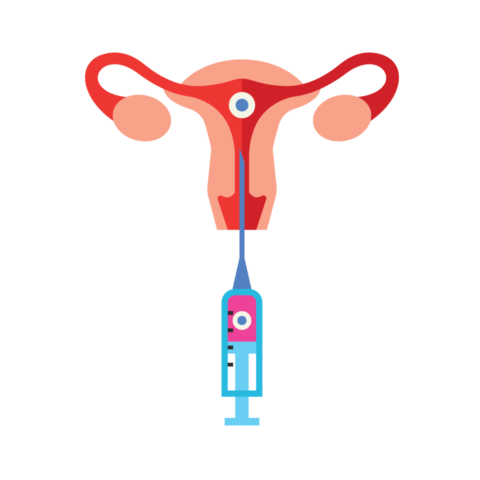 embryo transfer