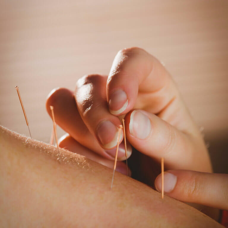 acupuncture for natural fertility