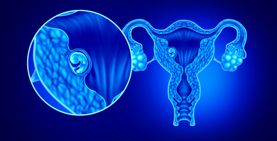 implantation