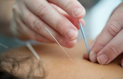 Person doing acupuncture.