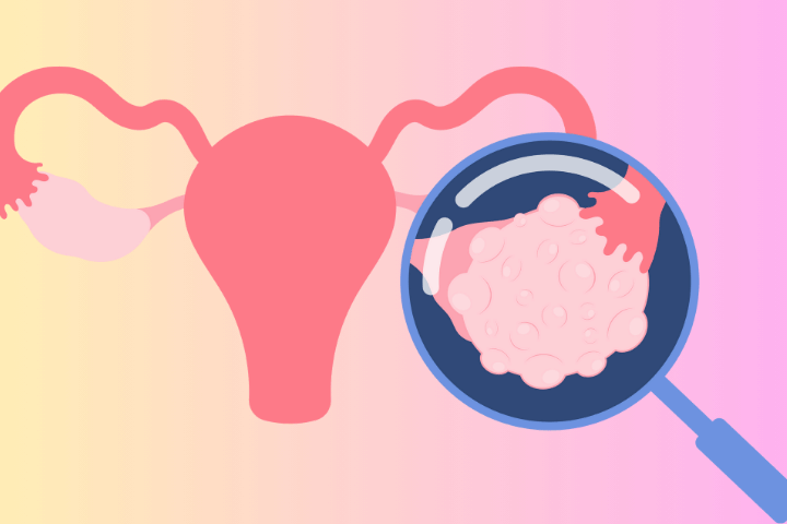 An image of an hyperstimulated ovary, OHSS