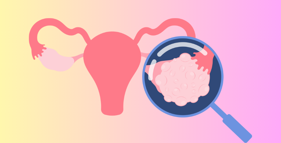 An image of an hyperstimulated ovary, OHSS